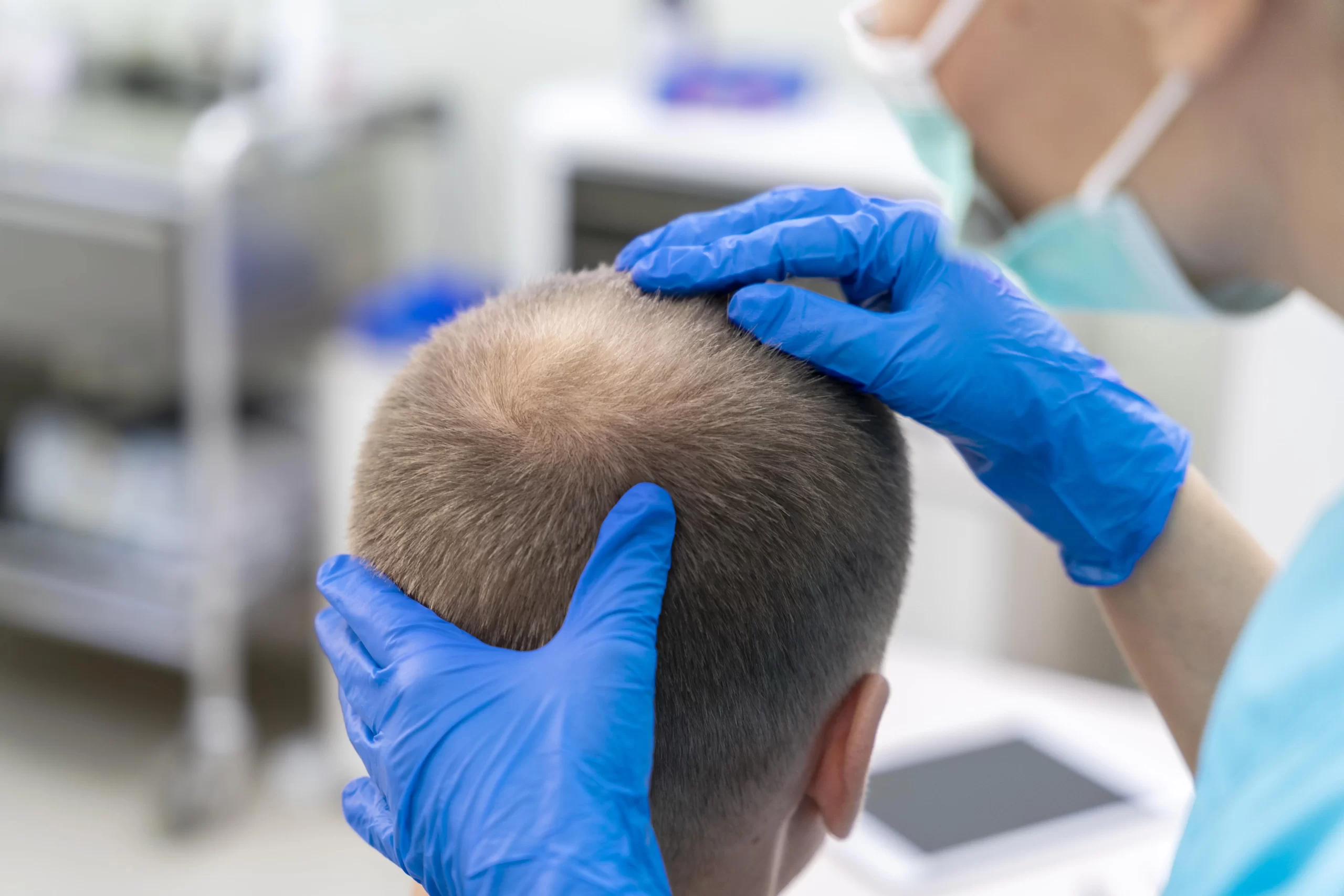 Protez Saç Analizi Nasıl Yapılır?