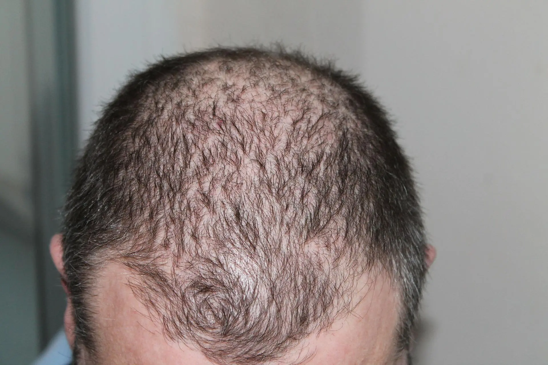 Bölgesel Saç Dökülmelerinde Protez Saç Uygulanır Mı?