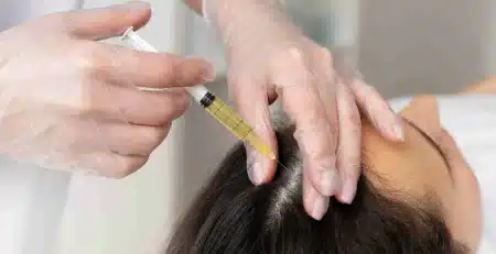 Saç Dökülmesi Tedavisinde Hangi Yöntemler Etkilidir?